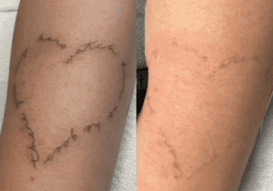 Laser Tattoo Removal Leeds