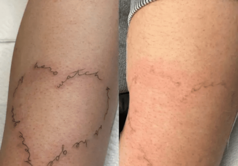 Laser Tattoo Removal Leeds