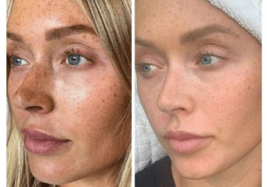 Professional Treatments for Post-Summer Pigmentation and Sun Damage