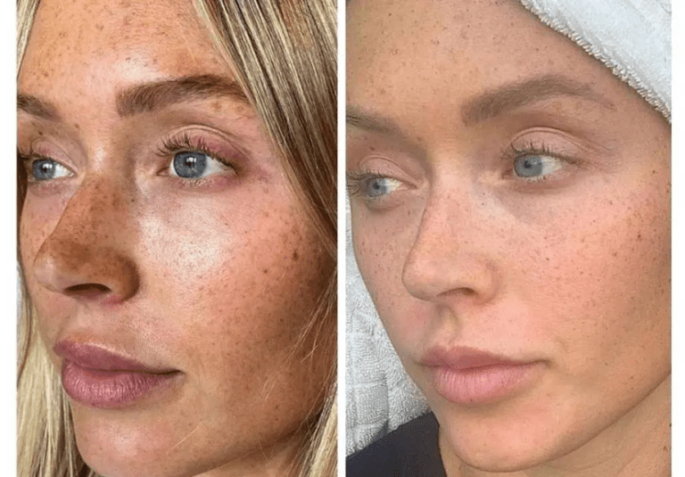 pigmentation-treatment
