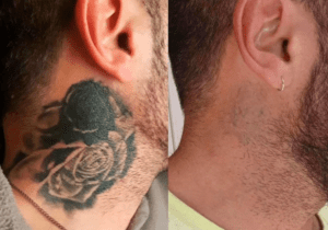 laser-tattoo-removal-cheshire