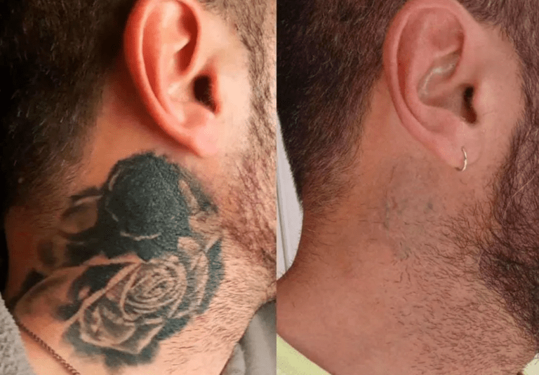 laser-tattoo-removal-cheshire