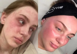 Chemical Peel Aftercare