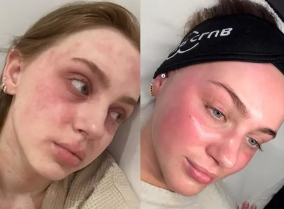 Chemical Peel Aftercare