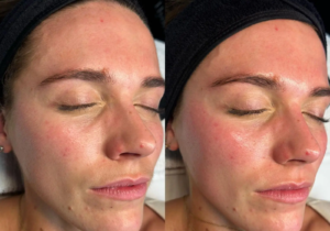 Hydrafacial Treatment