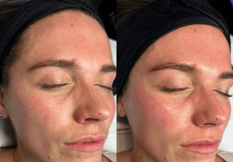 Hydrafacial Treatment