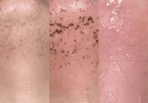 facial-hair-removal-dublin-guide