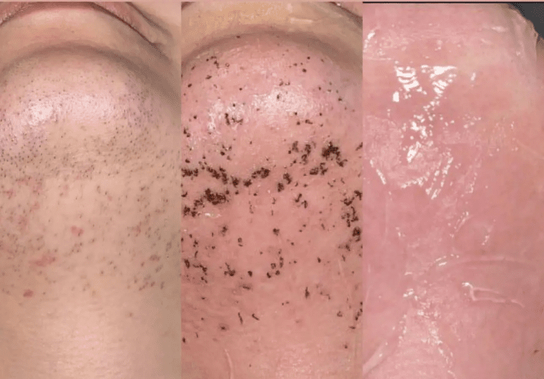 facial-hair-removal-dublin-guide
