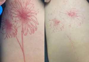 Tattoo Removal UK: A Complete Guide Before Starting Laser Treatment
