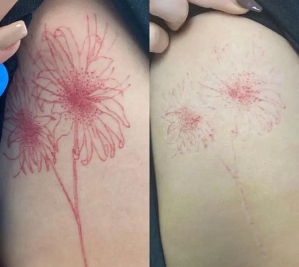 Tattoo Removal UK