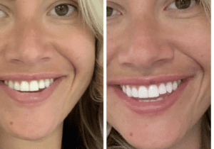 Best Teeth Whitening in Leeds: Dentist-Approved Laser Treatments Explained