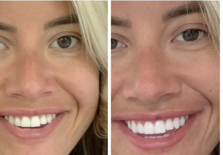 Best Teeth Whitening in Leeds: Dentist-Approved Laser Treatments Explained