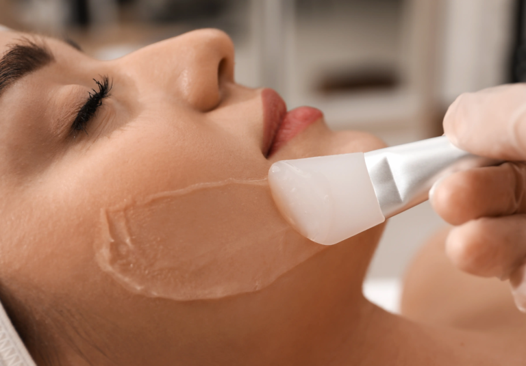 Chemical Peel for Oily Skin