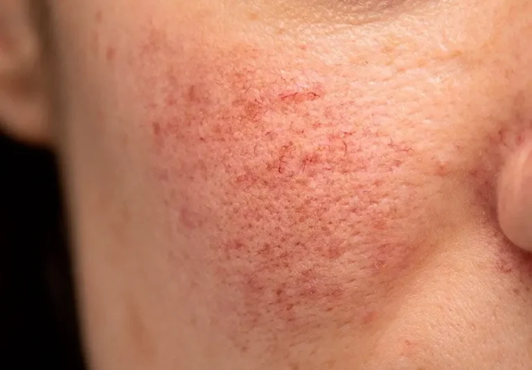 Early Stages of Rosacea
