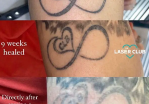 Does Laser Tattoo Removal Leave Scars? Here’s What You Should Know