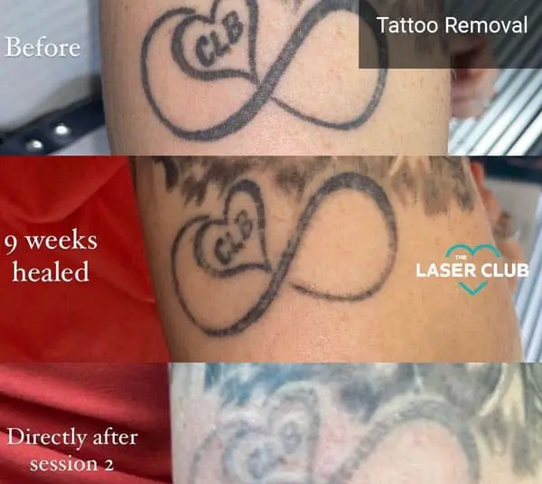 Laser Tattoo Removal Leave Scars