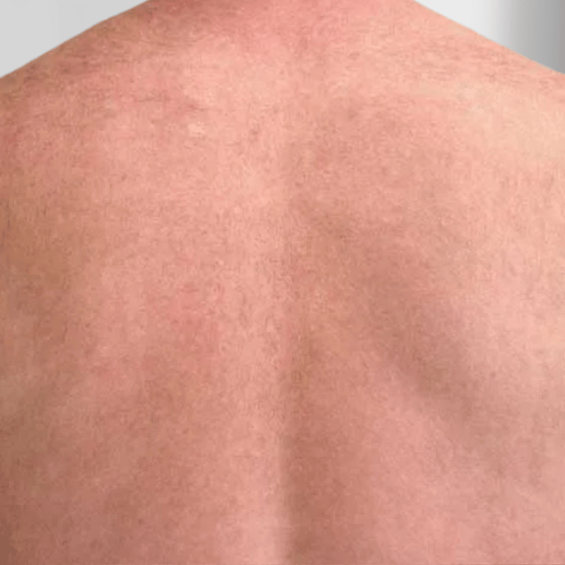 Laser Hair Removal