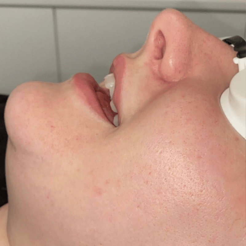 Laser Hair Removal Leeds