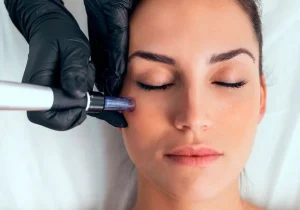The Top Benefits of Microneedling for Healthier, Smoother Skin