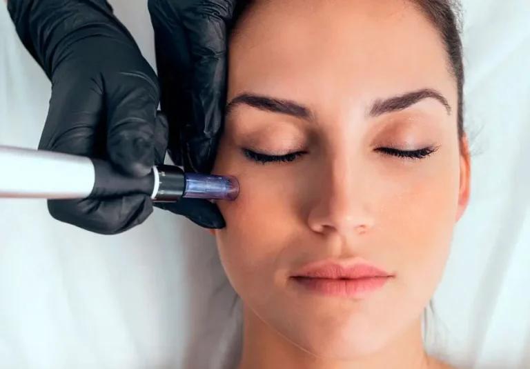 Benefits of Microneedling for Healthier,