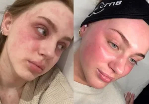 sun damage treatment