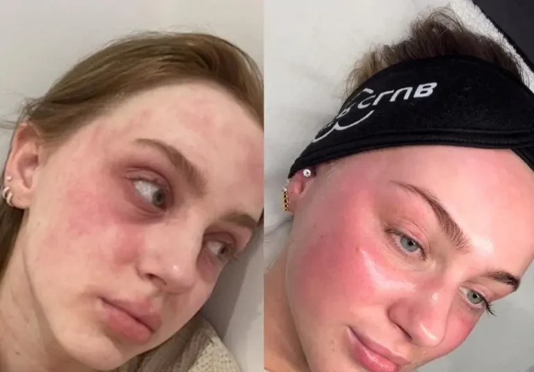 sun damage treatment